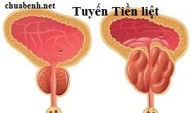 Phì đại tiền liệt tuyến là gì?