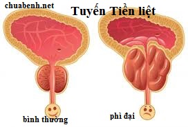 Phì đại tiền liệt tuyến là gì?