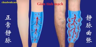 Châm cứu chữa giãn tĩnh mạch có hiệu quả không?