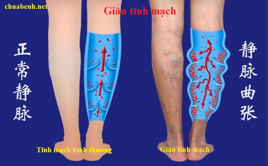 Châm cứu chữa giãn tĩnh mạch có hiệu quả không?