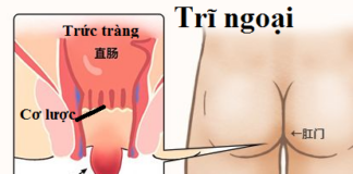 Bệnh Trĩ ngoại