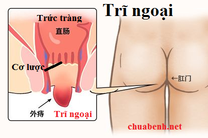 Bệnh Trĩ ngoại