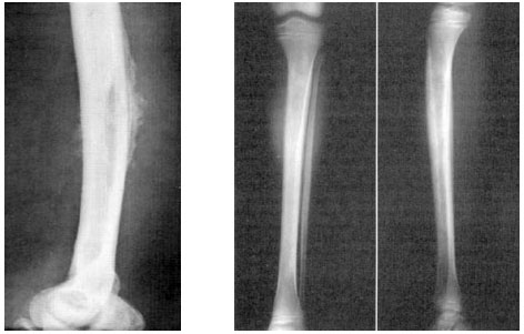 X-quang viêm xương đùi và xương chày