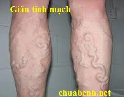 Giãn tĩnh mạch
