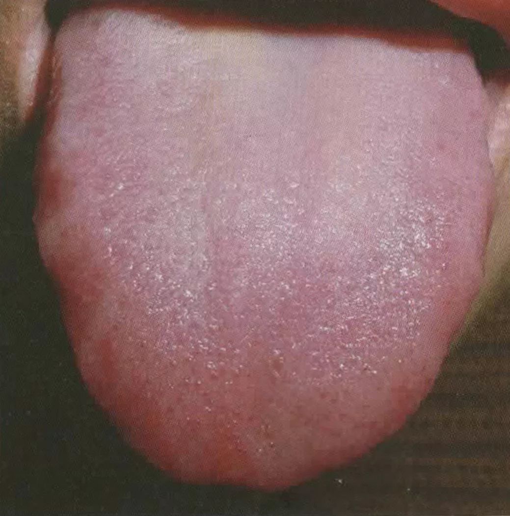 Lưỡi của chứng Súc huyết