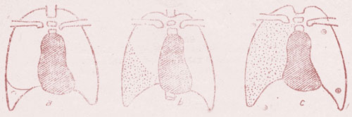 x quang tràn dịch màng phổi